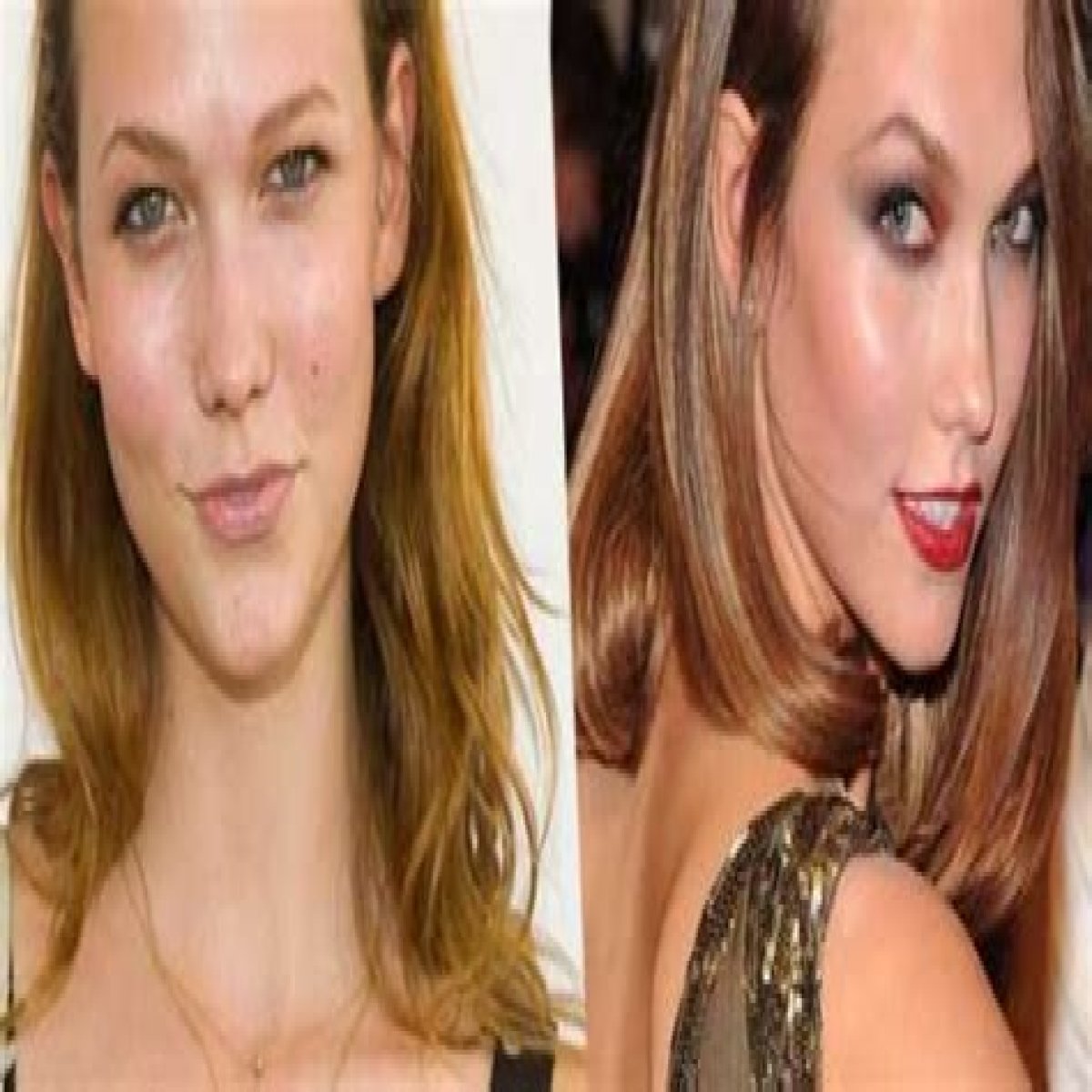 Karlie Kloss Plastic Surgery Before and After