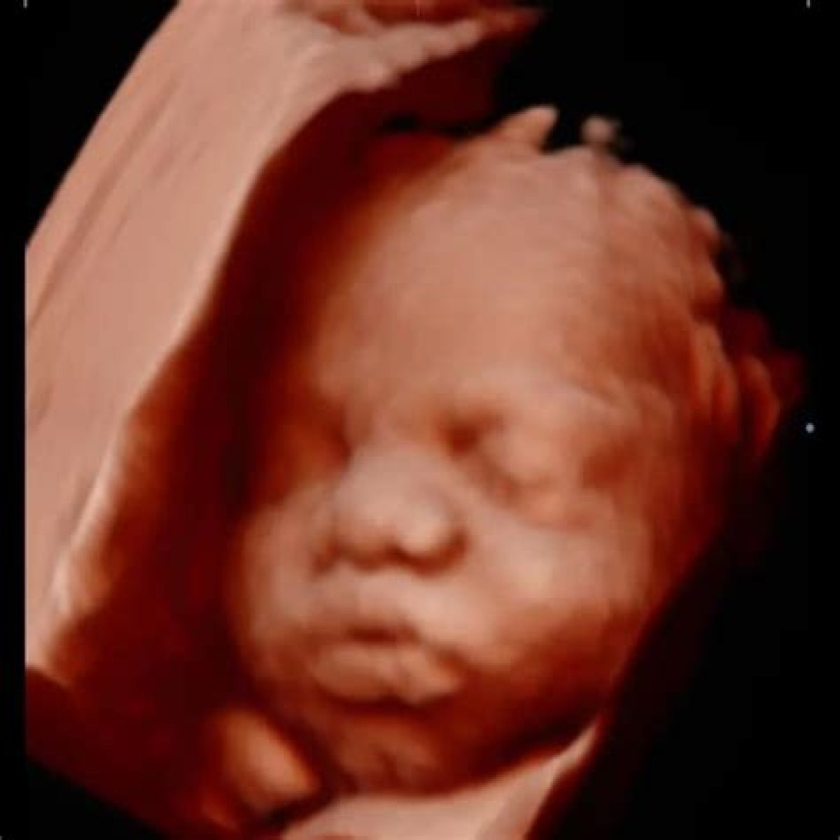 Unveiling The Secrets: Ultrasound Big Lips